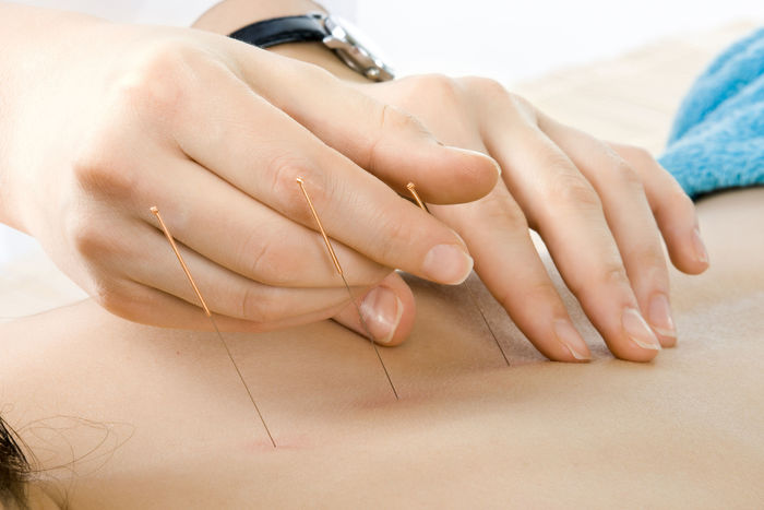 Acupuncture – Is It an Effective Treatment for Sports Injuries?