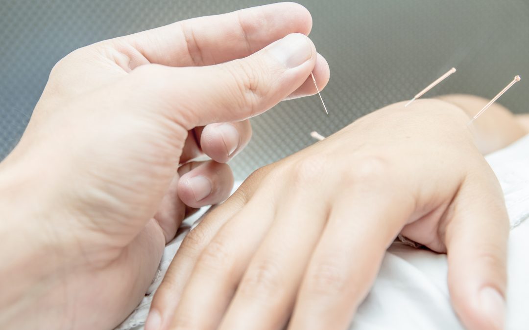 Acupuncture patient with needles along arm