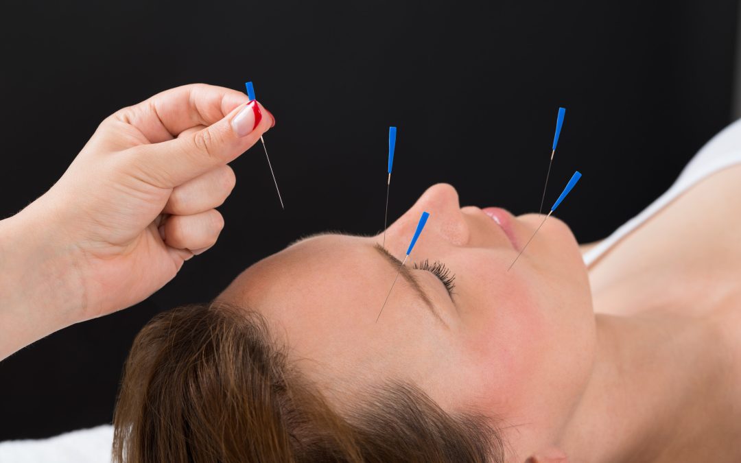 Close-up Person Hands Putting Acupuncture Needle On Face Of Young Woman