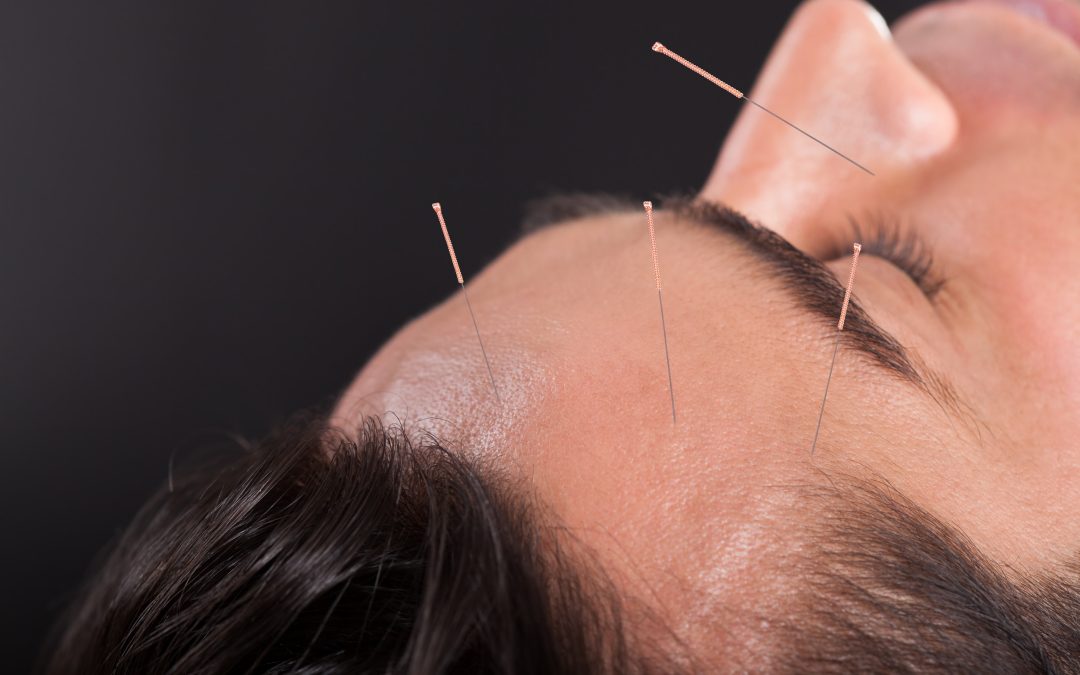 Close-up Of A Young Man Undergoing Acupuncture Treatment At Spa