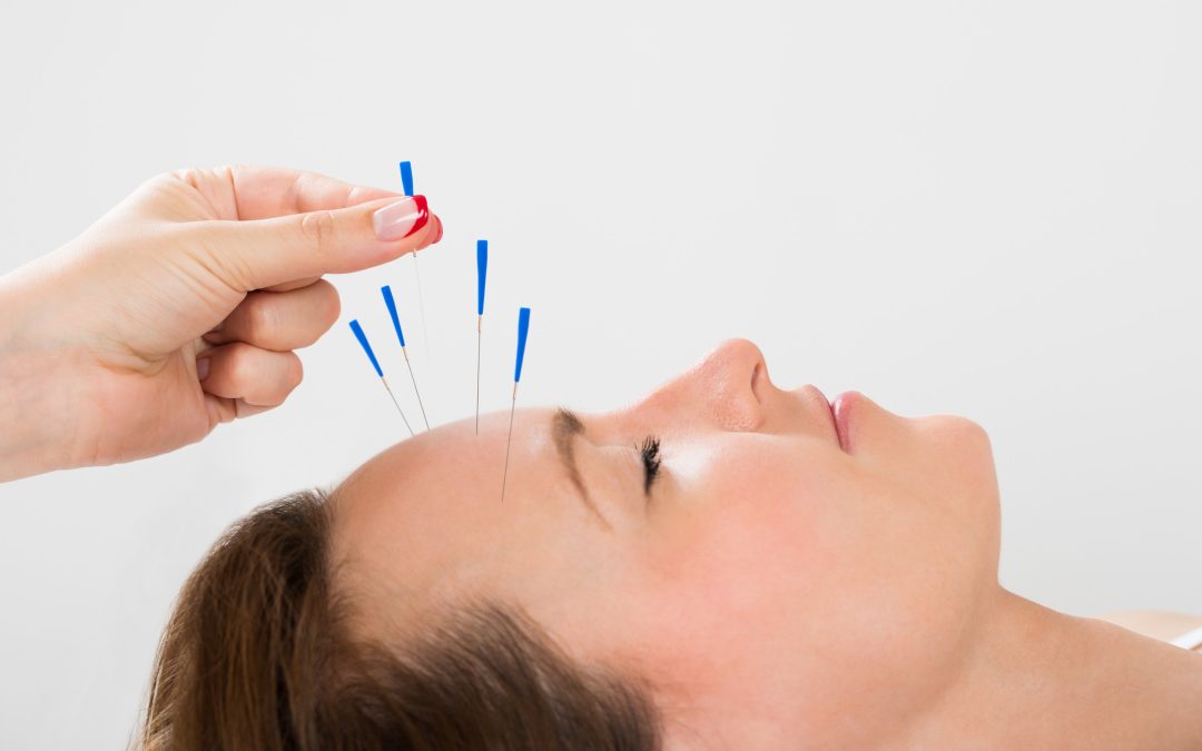 Close-up Of Young Beautiful Woman Receiving Acupuncture Treatment