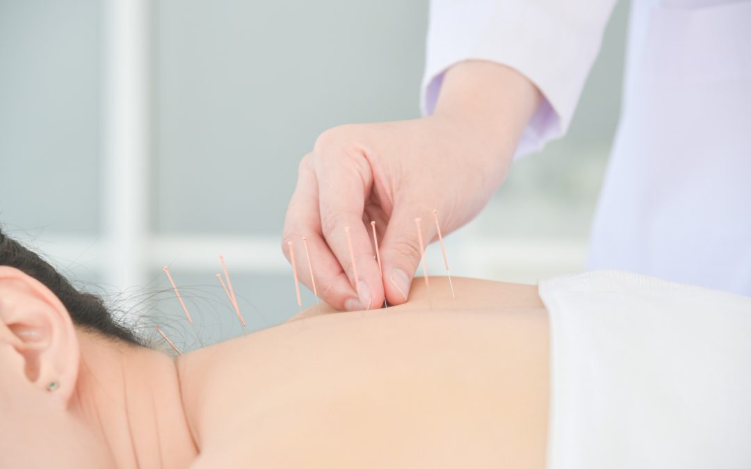 acupuncturist sticks needles on the back of a man