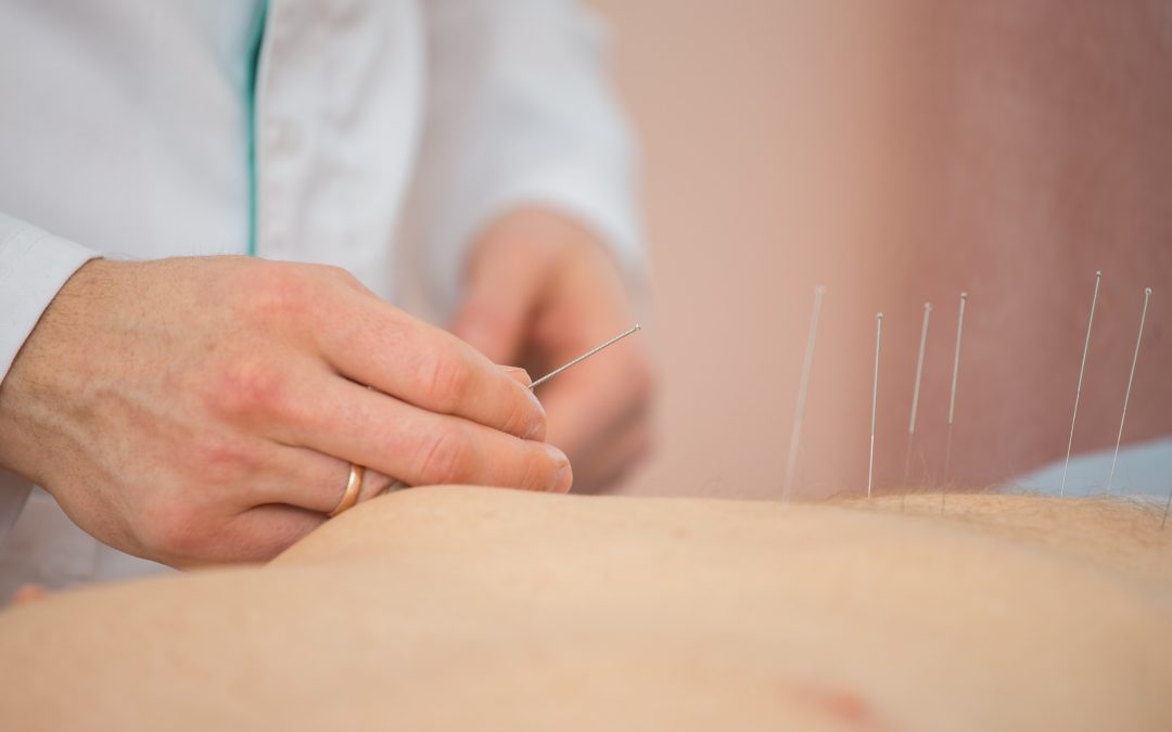 acupuncturist inserting a needle on a man's abdomen