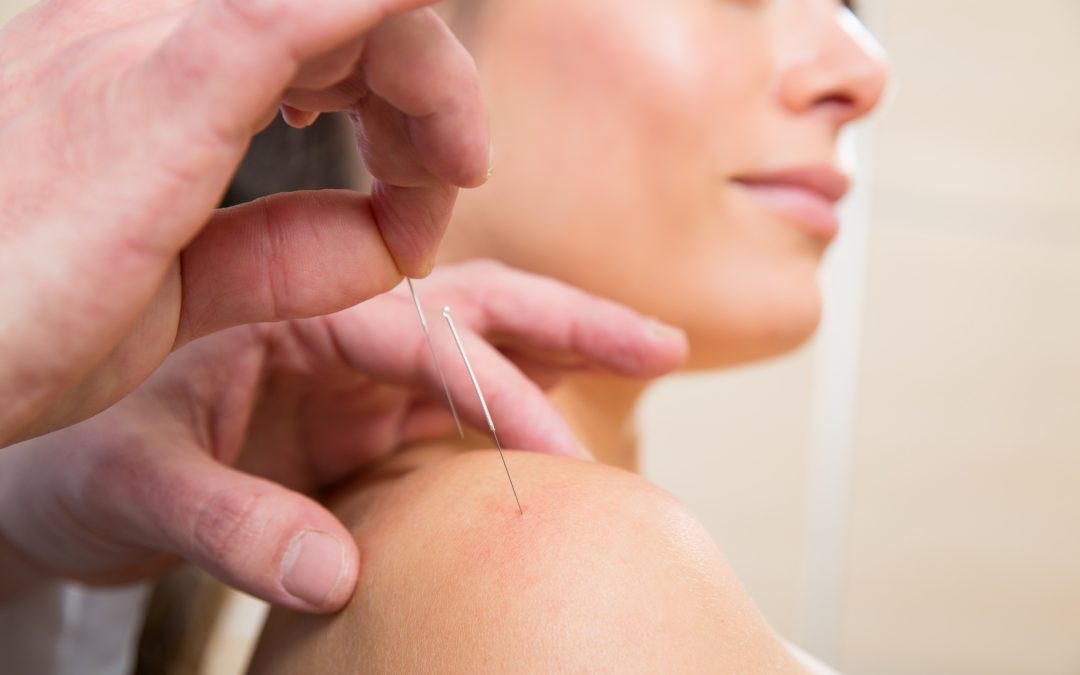 acupuncture needles on the shoulder