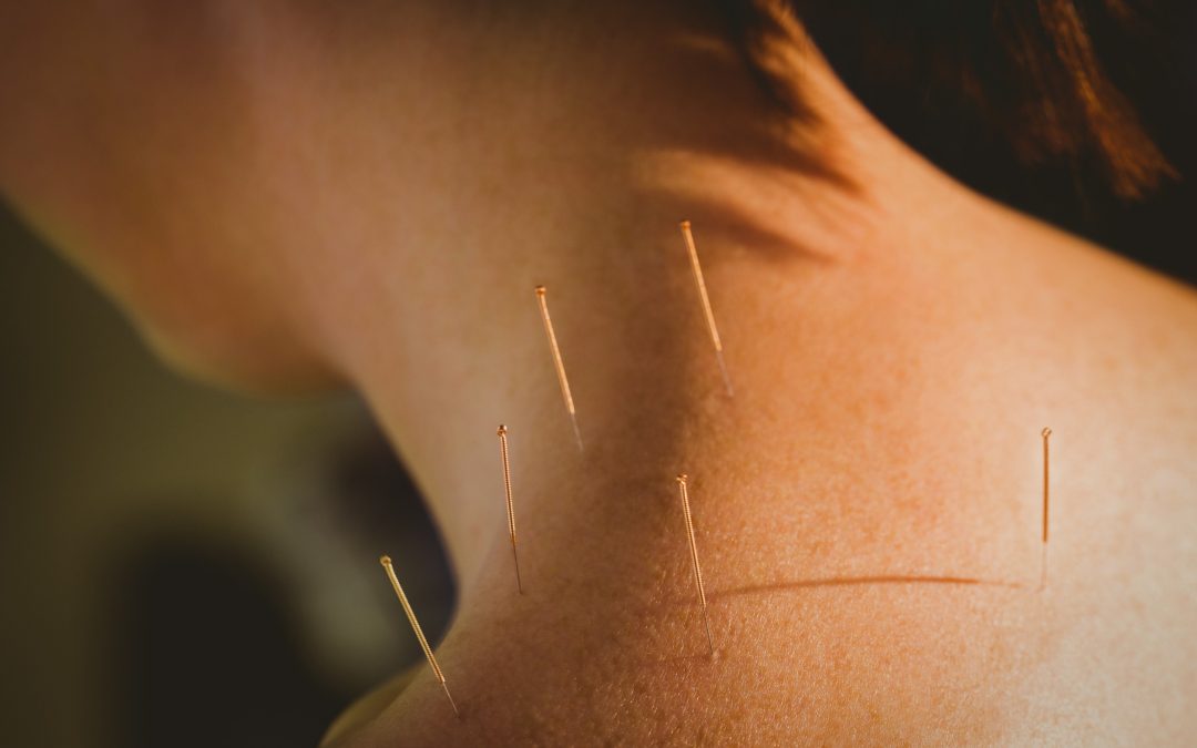 acupuncture eedles on shoulder and neck area