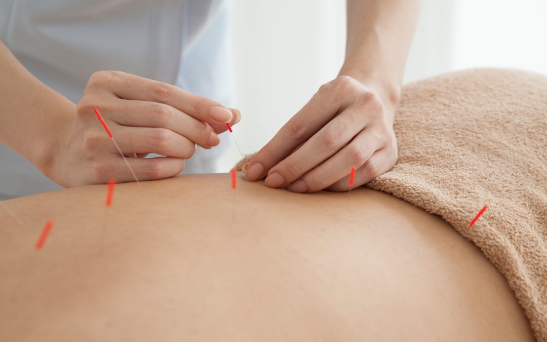 acupunturist sticking needles on the person's back