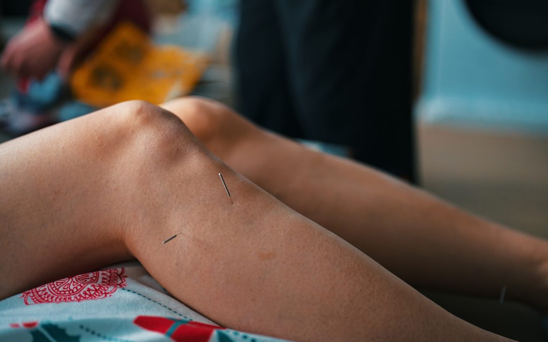 Therapy of female leg with acupuncture needles
